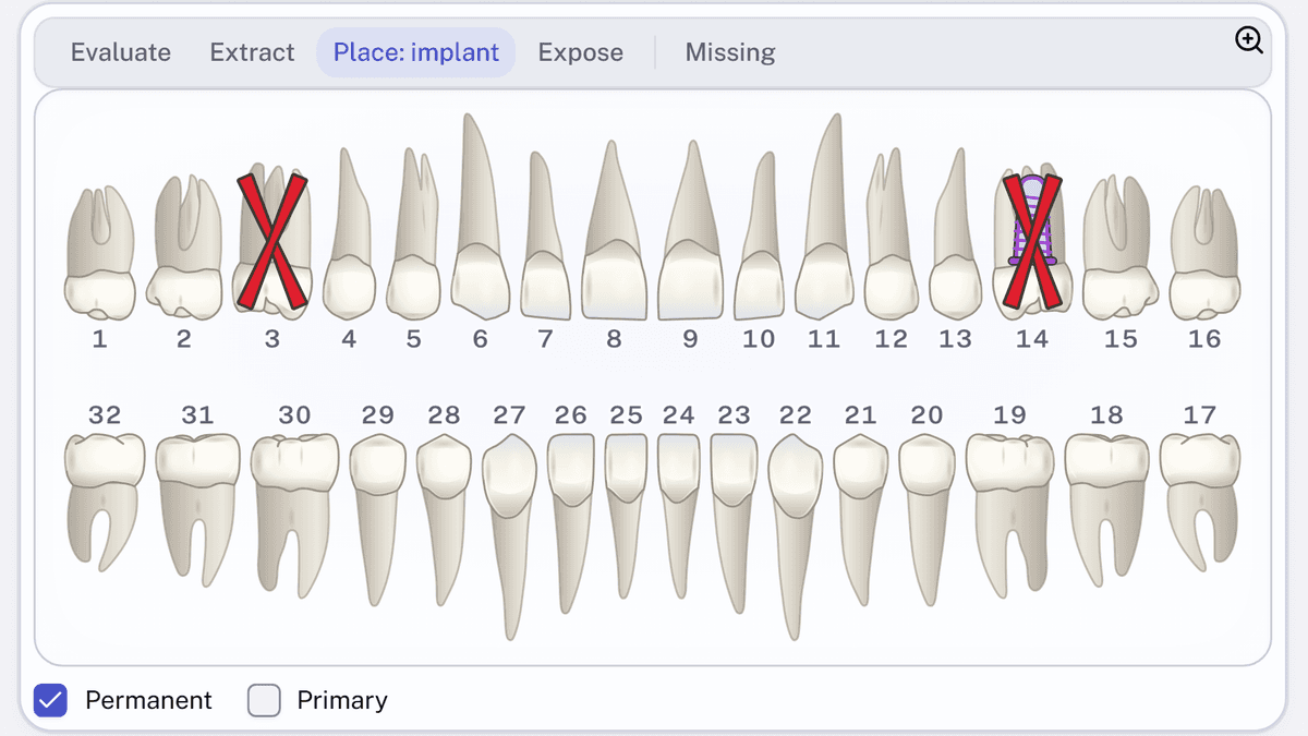 The tooth chart on an oral surgery referral, drawn from the front. The toolbar above it offers Evaluate, Extract, Place: implant, Expose and Missing, with Place: implant selected. Tooth 3 carries a red cross for Extract, and tooth 14 carries the red cross with a purple implant drawn under it.